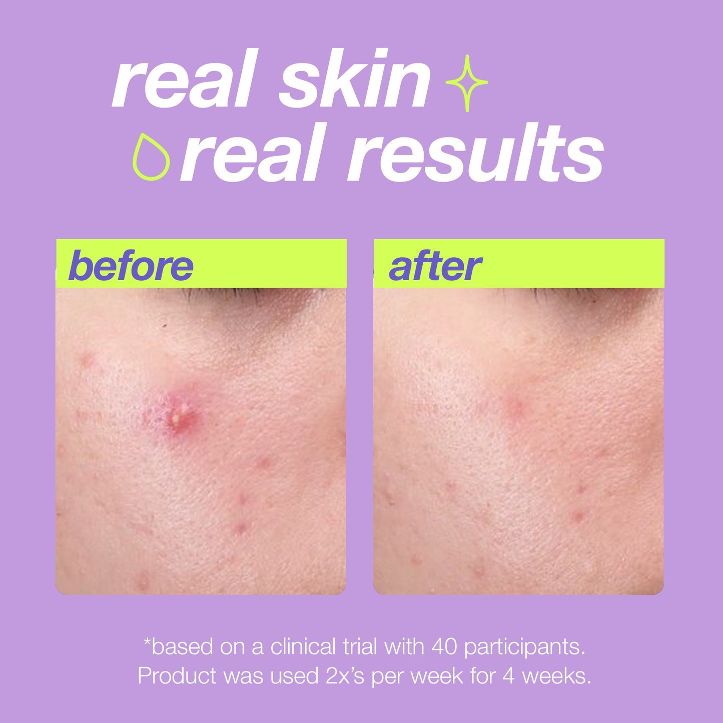 Before and after results using Breakout Clearing Liquid Peel 